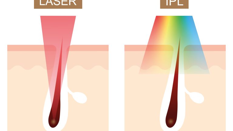 Schaubild mit dem Vergleich zwischen Laser- und IPL-Haarentfernung. Schaubild mit dem Vergleich zwischen Laser- und IPL-Haarentfernung.
